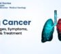 lung cancer blog 90x80