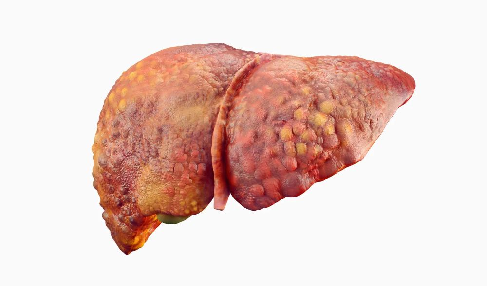 Liver Cancer Treatment in Delhi