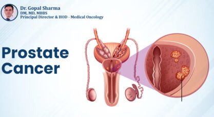 Treatment for Prostate Cancer in Delhi