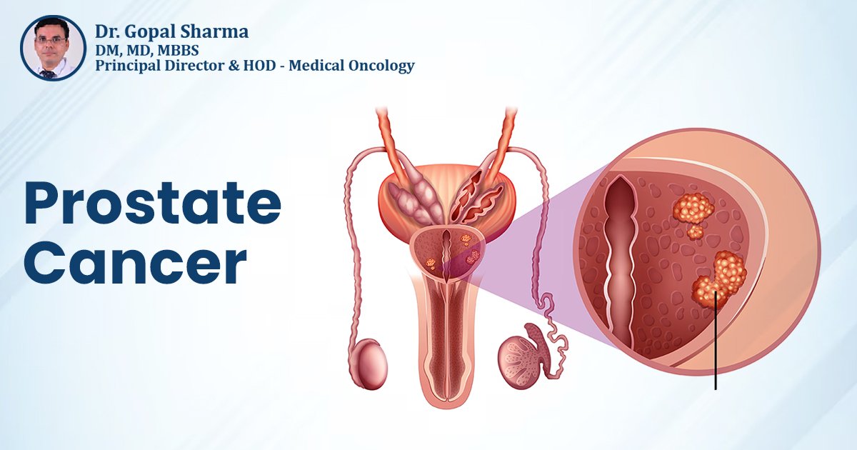 Treatment for Prostate Cancer in Delhi