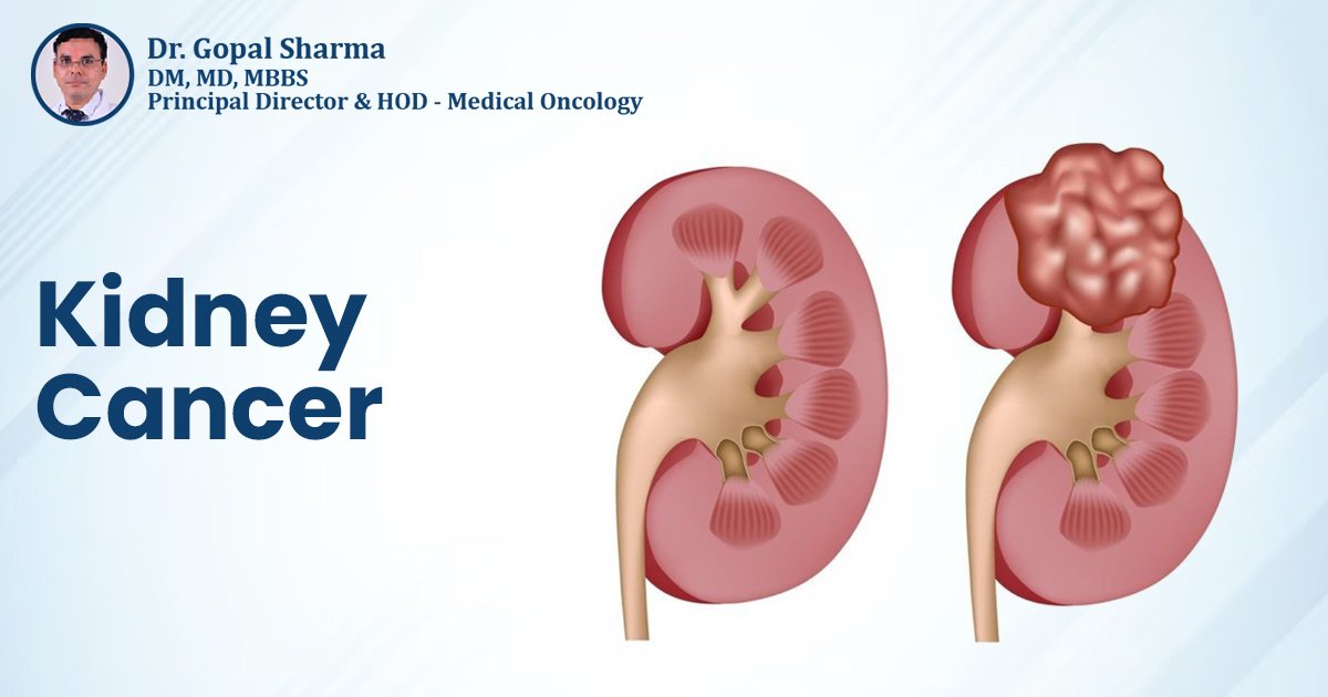 Kidney Cancer Treatment in Delhi